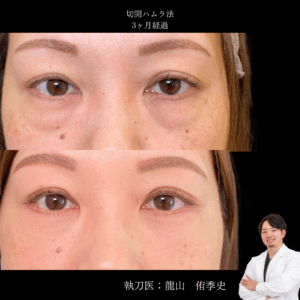 裏ハムラ法術後3ヶ月
