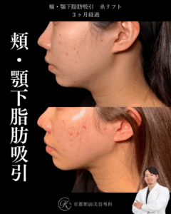 頬・顎下脂肪吸引・糸リフトの症例写真（京都駅前美容外科の症例画像）