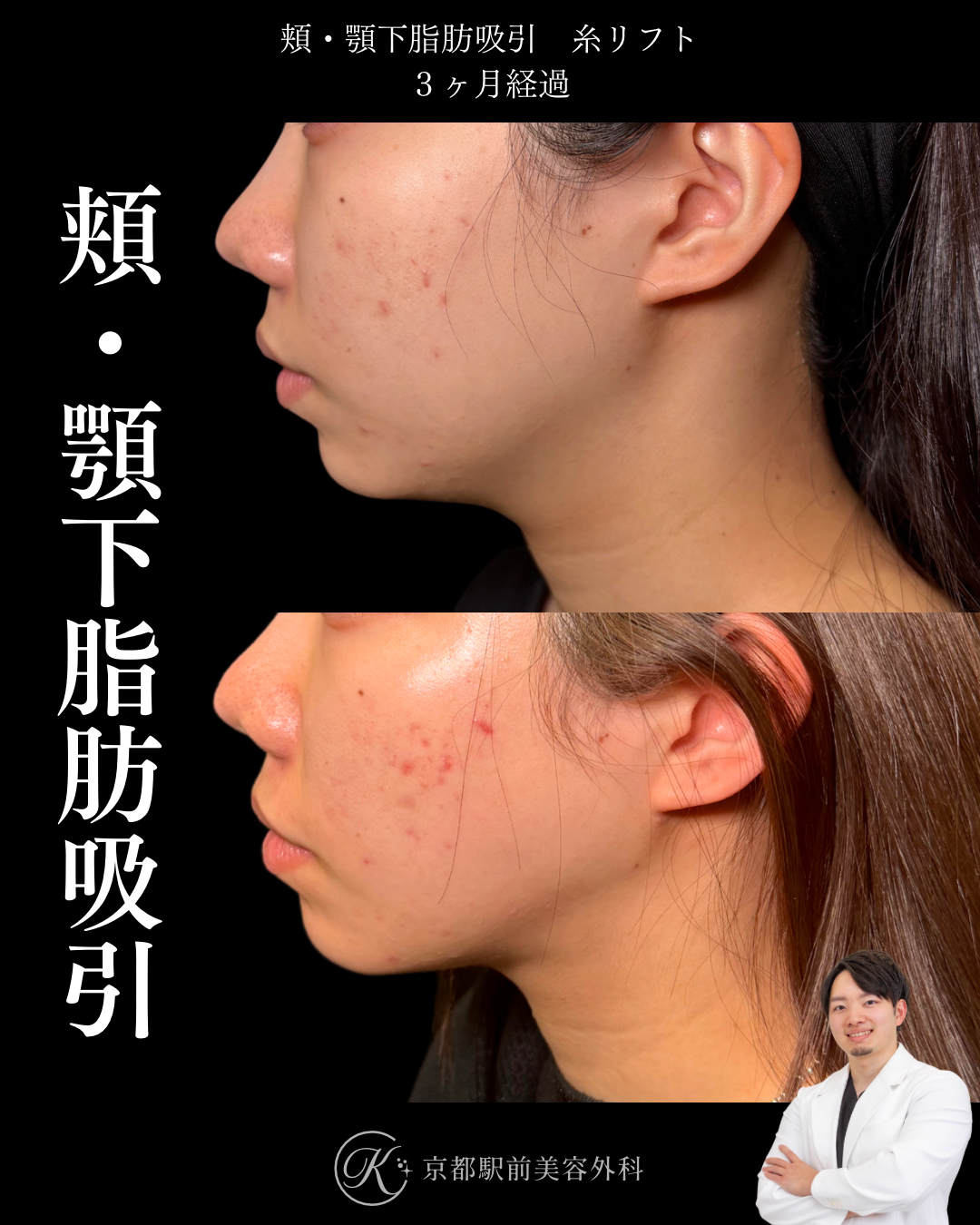 頬・顎下脂肪吸引・糸リフトの症例写真（京都駅前美容外科の症例画像）