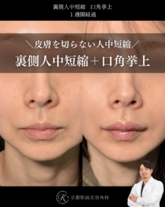 裏側人中短縮と口角挙上（全層法）の症例（京都駅前美容外科の症例写真）