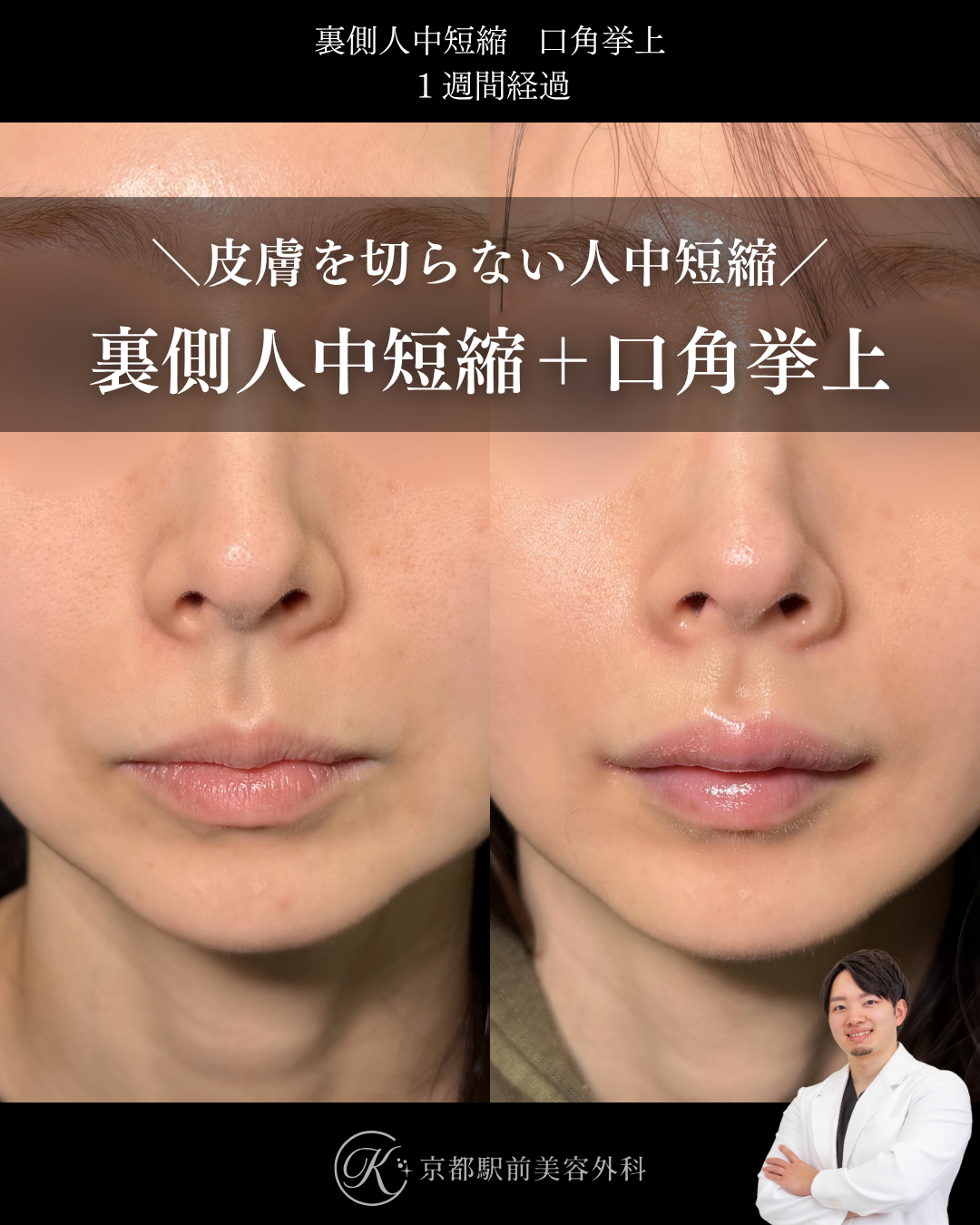 裏側人中短縮と口角挙上(全層法)の症例(京都駅前美容外科の症例写真)