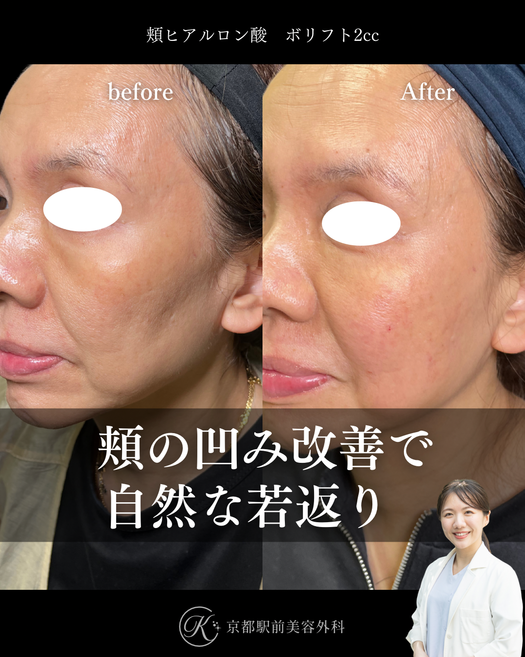 頬コケ　ヒアルロン酸