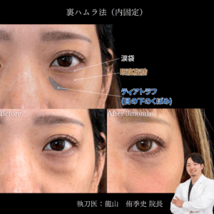 裏ハムラ術後3ヶ月説明