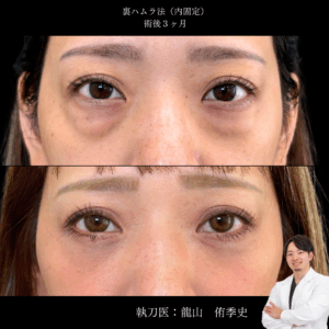 裏ハムラ術後3ヶ月