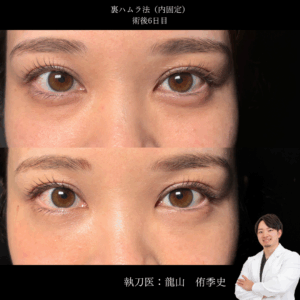 裏ハムラ術後3日