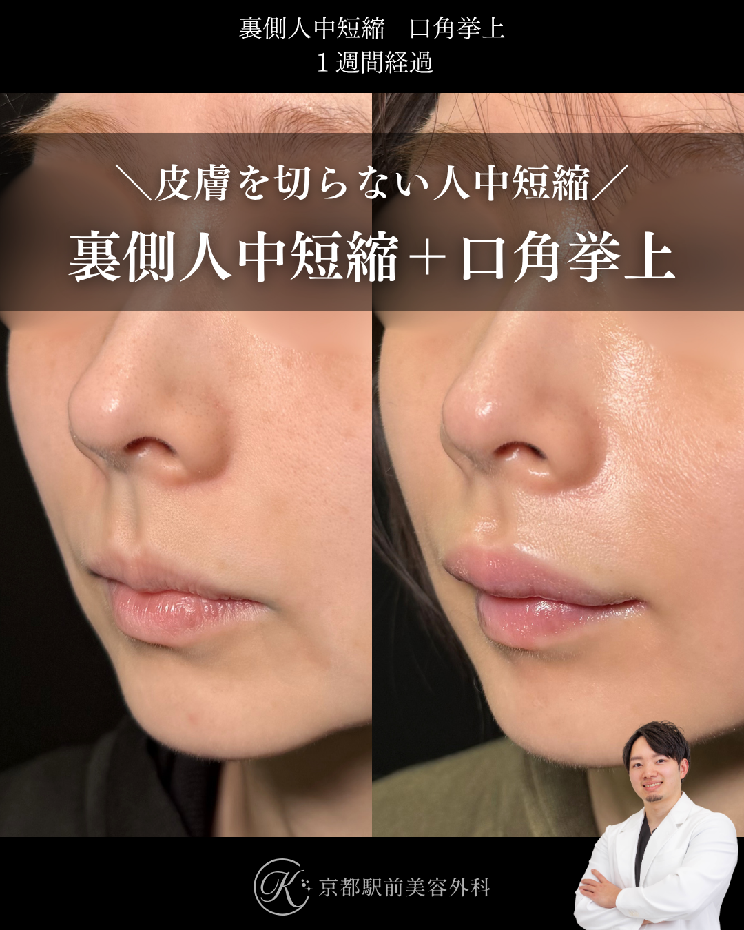 裏側人中短縮と口角挙上（全層法）の症例（京都駅前美容外科の症例写真）