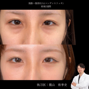 脱脂+脂肪注入 術後2週間