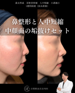 鼻整形と人中短縮、中顔面の垢抜けセット（京都駅前美容外科の症例）