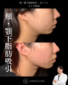 頬・顎下脂肪吸引・糸リフトの症例写真（京都駅前美容外科の症例画像）