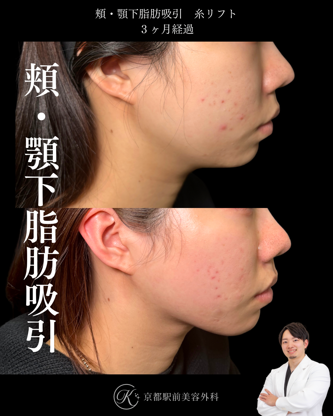 頬・顎下脂肪吸引・糸リフトの症例写真（京都駅前美容外科の症例画像）