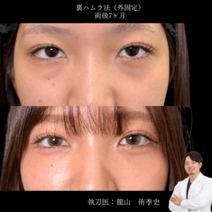 裏ハムラ法術後2週間