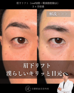 眉下切開(眉下リフト)の3ヶ月経過写真(roof切除・眼窩脂肪除去)(京都駅前美容外科の目元症例)