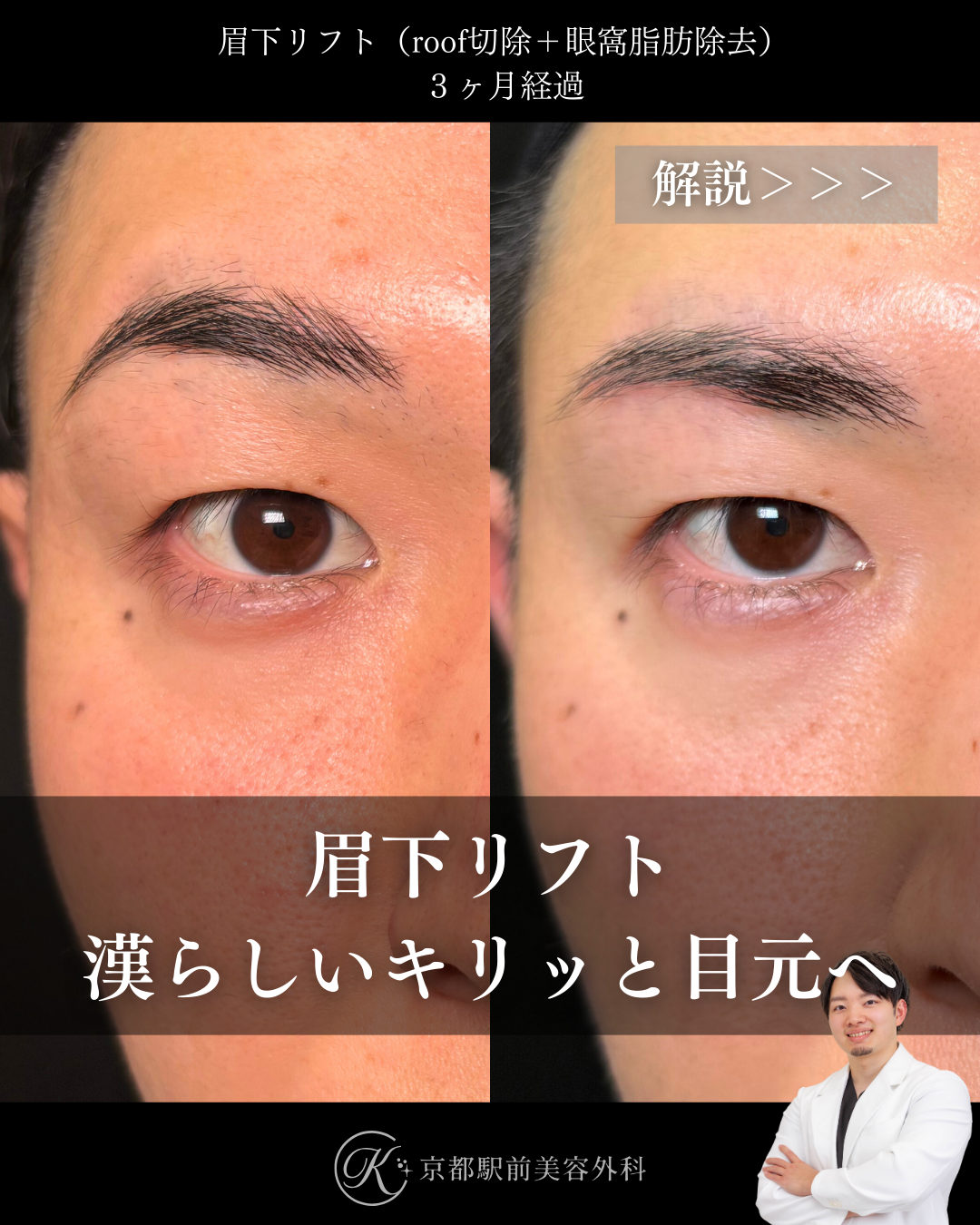 眉下切開（眉下リフト）の３ヶ月経過写真（roof切除・眼窩脂肪除去）（京都駅前美容外科の目元症例）
