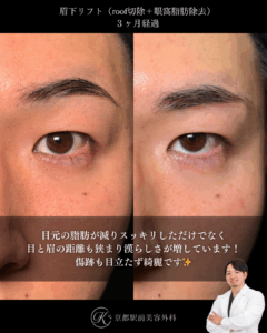 眉下切開（眉下リフト）の３ヶ月経過写真（roof切除・眼窩脂肪除去）（京都駅前美容外科の目元症例）