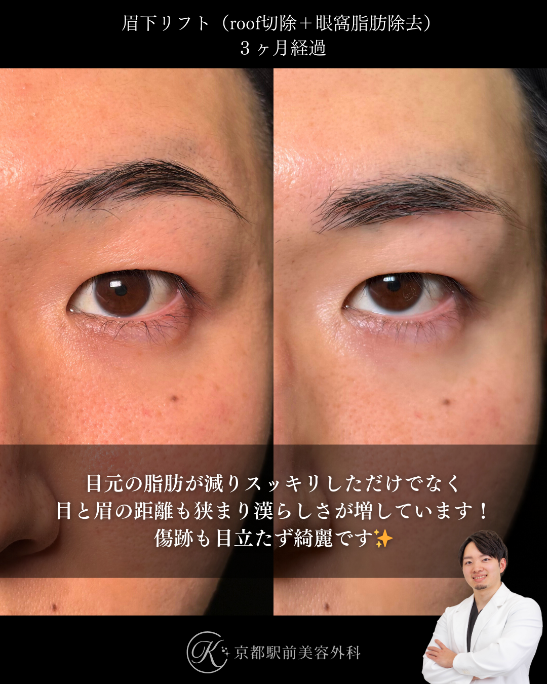 眉下切開（眉下リフト）の３ヶ月経過写真（roof切除・眼窩脂肪除去）（京都駅前美容外科の目元症例）