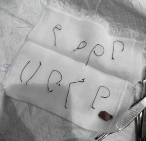 鼻筋のメッシュ（修正手術時に抜去したもの）