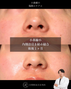 小鼻縮小内側法の術後症例画像(京都駅前美容外科の症例写真)