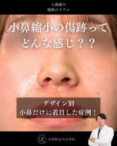 小鼻縮小の傷跡ってどんな感じ?デザインや術式別にまとめ解説。京都駅前美容外科の症例写真