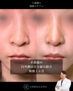 小鼻縮小内外側法の術後症例画像(京都駅前美容外科の症例写真)