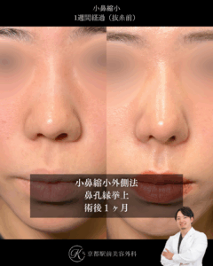 小鼻縮小外側法と鼻孔縁挙上術の術後症例画像(京都駅前美容外科の症例写真)