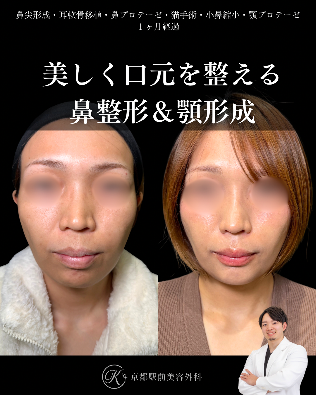 鼻尖形成・耳軟骨移植・鼻プロテーゼ・猫手術・小鼻縮小・顎プロテーゼの１ヶ月後写真（京都駅前美容外科の鼻整形症例）