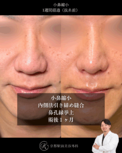 小鼻縮小内側法と鼻孔縁挙上術の術後症例画像(京都駅前美容外科の症例写真)