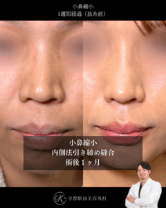 小鼻縮小内側法の術後症例画像(京都駅前美容外科の症例写真)