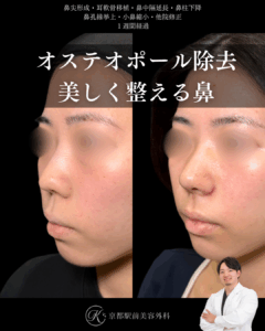 オステオポール除去で美しく整える鼻、鼻尖形成、耳軟骨移植、保存軟骨による鼻中隔延長、小鼻縮小、鼻孔縁挙上など（京都駅前美容外科の症例画像）