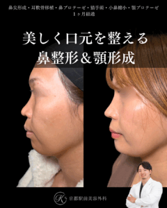 鼻尖形成・耳軟骨移植・鼻プロテーゼ・猫手術・小鼻縮小・顎プロテーゼの１ヶ月後写真（京都駅前美容外科の鼻整形症例）