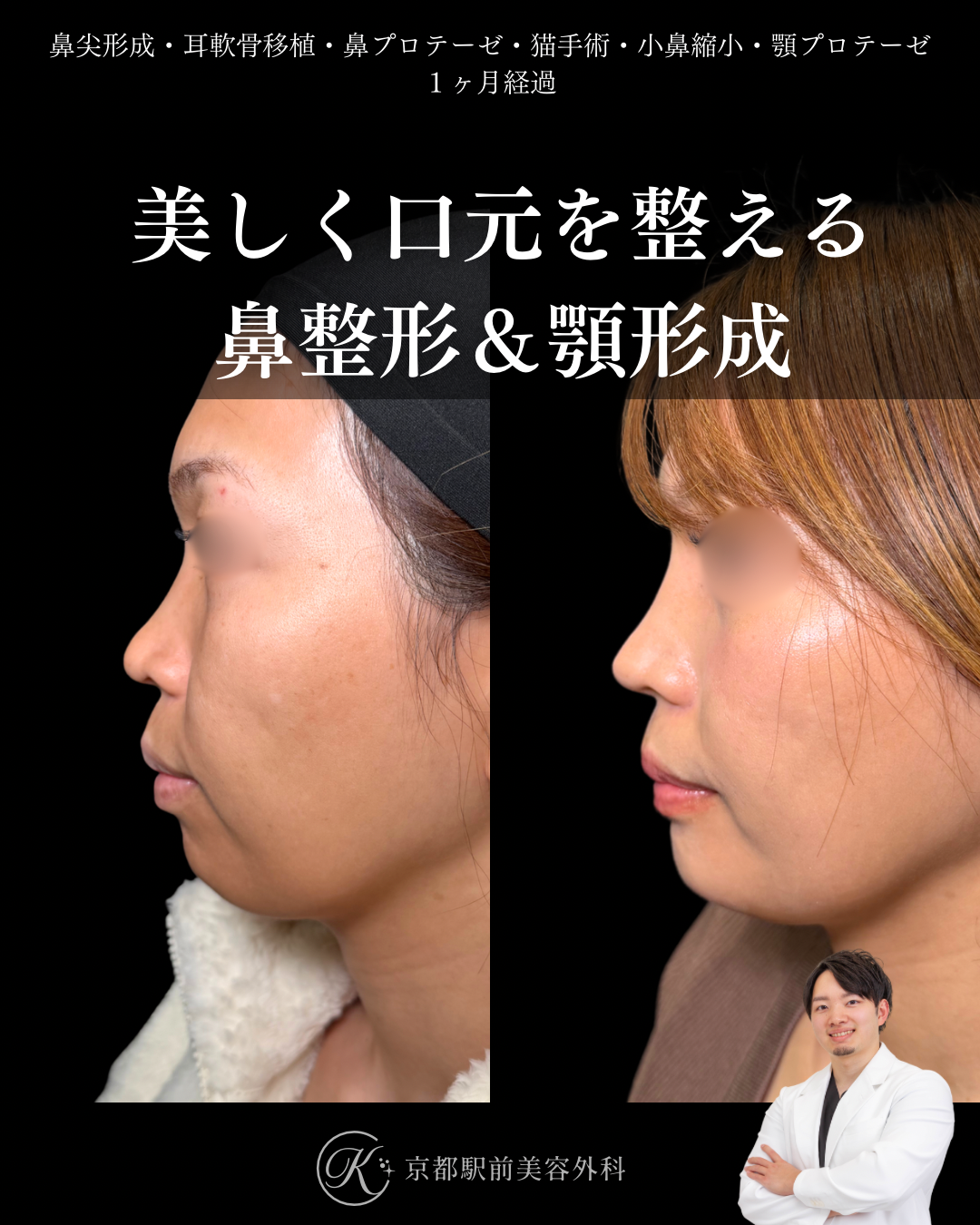 鼻尖形成・耳軟骨移植・鼻プロテーゼ・猫手術・小鼻縮小・顎プロテーゼの1ヶ月後写真(京都駅前美容外科の鼻整形症例)