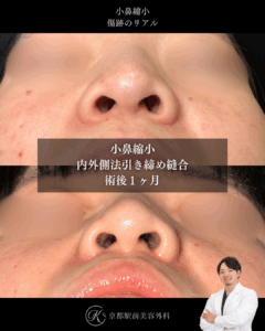 小鼻縮小内外側法の術後症例画像(京都駅前美容外科の症例写真)