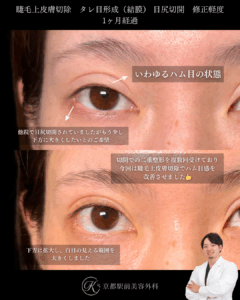 睫毛上皮膚切除でハム目解消、タレ目形成と目尻切開でデカ目に。京都駅前美容外科の症例画像
