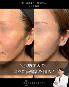 自然な輪郭美を作る頬・こめかみの脂肪注入の症例（京都駅前美容外科の症例画像）