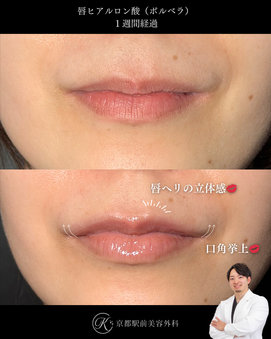 唇ヒアルロン酸で人中の立体感づくりと口角挙上。京都駅前美容外科の症例写真。