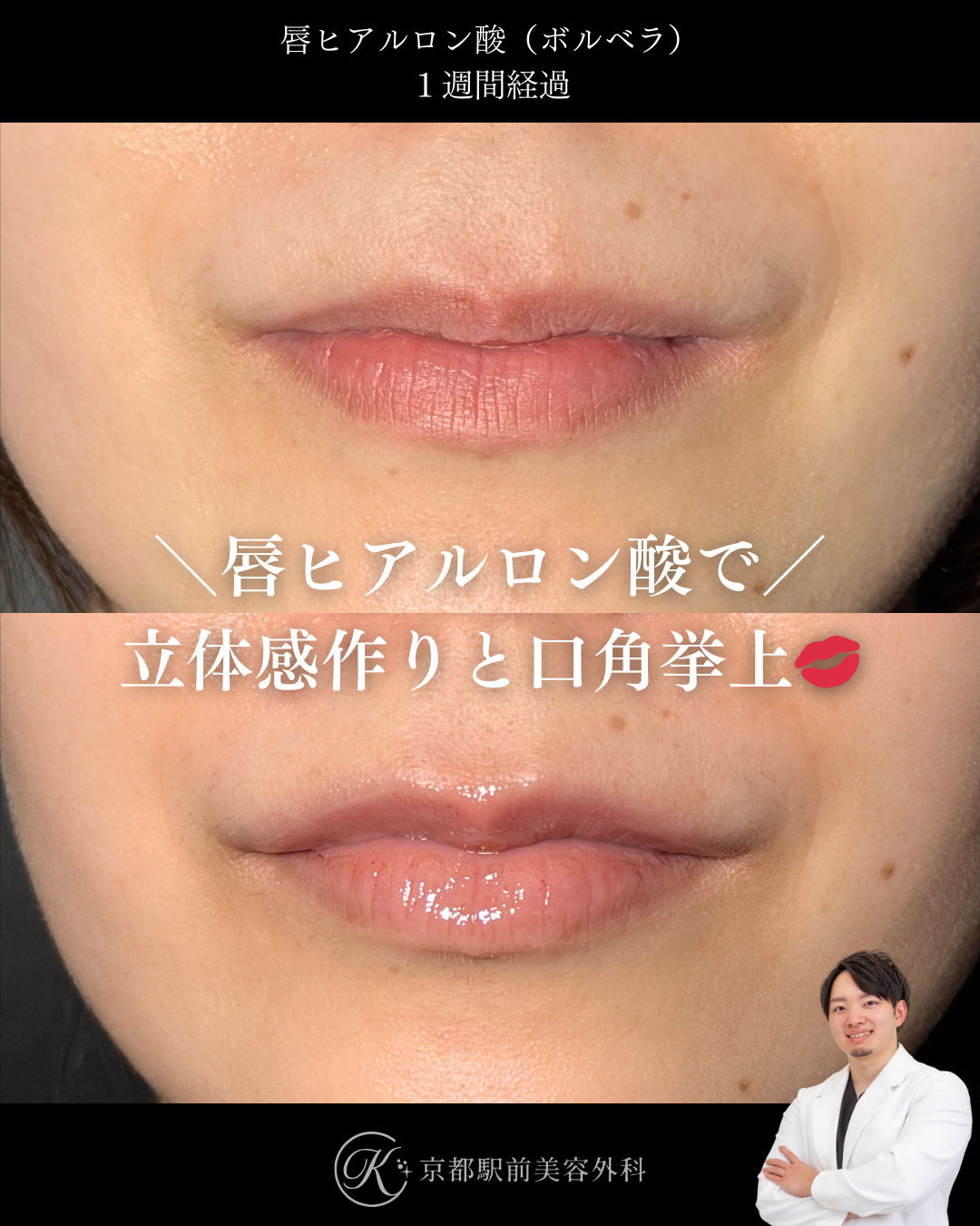唇ヒアルロン酸で人中の立体感づくりと口角挙上。京都駅前美容外科の症例写真。