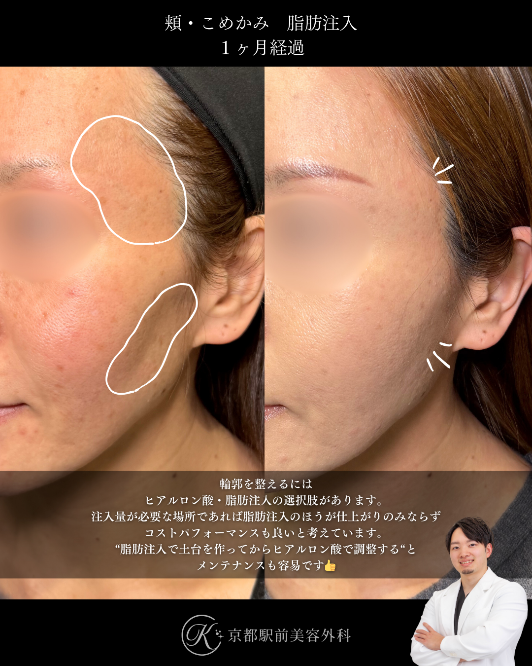 自然な輪郭美を作る頬・こめかみの脂肪注入の症例（京都駅前美容外科の症例画像）