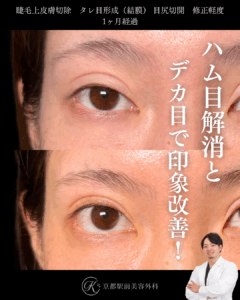 睫毛上皮膚切除でハム目解消、タレ目形成と目尻切開でデカ目に。京都駅前美容外科の症例画像