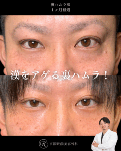 クマ取り、裏ハムラ法の術後経過。京都駅前美容外科の症例画像。