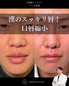 口唇縮小(上下)の術後経過。京都駅前美容外科の症例画像。