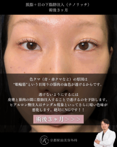 色クマはどうやって治す？脱脂と脂肪注入（ナノリッチ脂肪注入）の症例。京都駅前美容外科の症例画像。