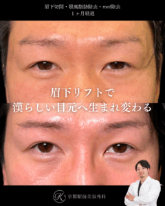 眉下リフト、眼窩脂肪除去、roof除去の術後経過。京都駅前美容外科の症例画像。