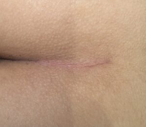 真皮脂肪移植(臀部からの採取)の3ヶ月後画像(京都駅前美容外科の写真)