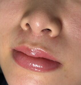 人中短縮と小鼻縮小によりできた傷跡にグラデーション治療施行して1ヶ月経過した写真(京都駅前美容外科の医療コラム写真)