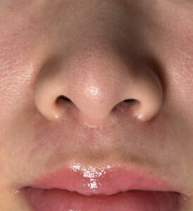 人中短縮と小鼻縮小によりできた傷跡にグラデーション治療施行して1ヶ月経過した写真(京都駅前美容外科の医療コラム写真)