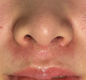 グラデーション治療2回目の施行直後の写真