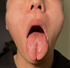 スプリットタン形成の術直後の状態（京都駅前美容外科の症例写真）