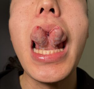 スプリットタン形成の術直後の状態（京都駅前美容外科の症例写真）