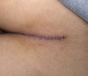 真皮脂肪移植(臀部からの採取)の術直後画像(京都駅前美容外科の写真)