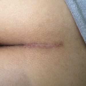 真皮脂肪移植(臀部からの採取)の1ヶ月後画像(京都駅前美容外科の写真)