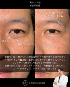 クマ取り、裏ハムラ法の術後経過。京都駅前美容外科の症例画像。